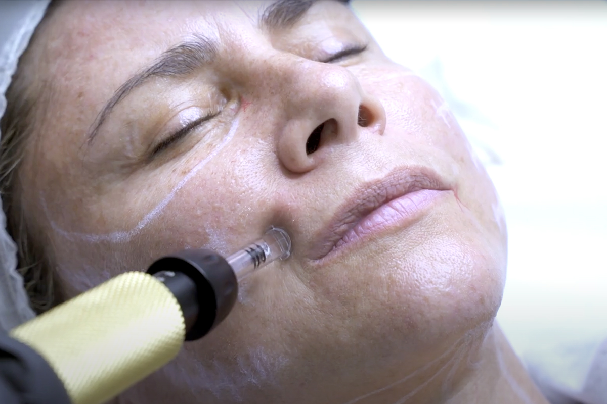 Nanobotox e Hilos Líquidos en Sevilla