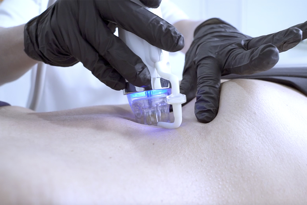 Radiofrecuencia Fraccionada en Abdomen en Sevilla
