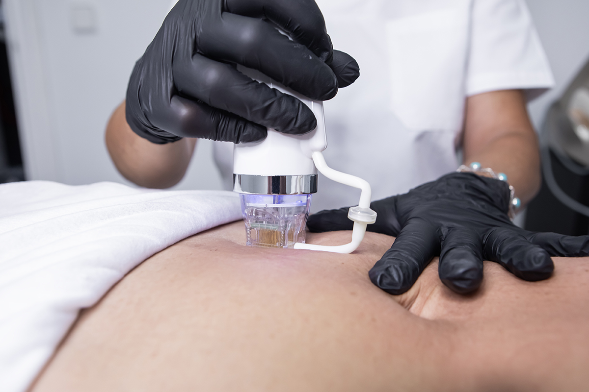 Radiofrecuencia Fraccionada en Abdomen en Sevilla