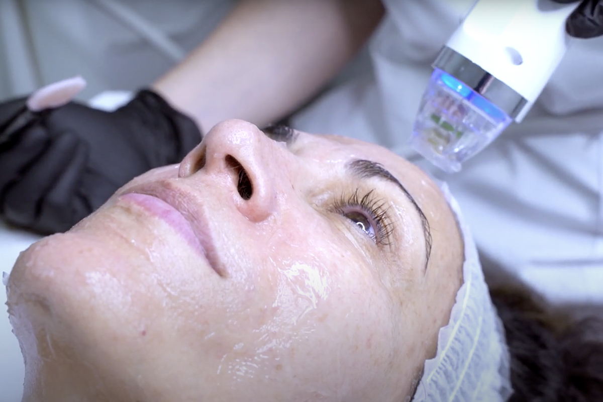 Rejuvenecimiento facial en Sevilla