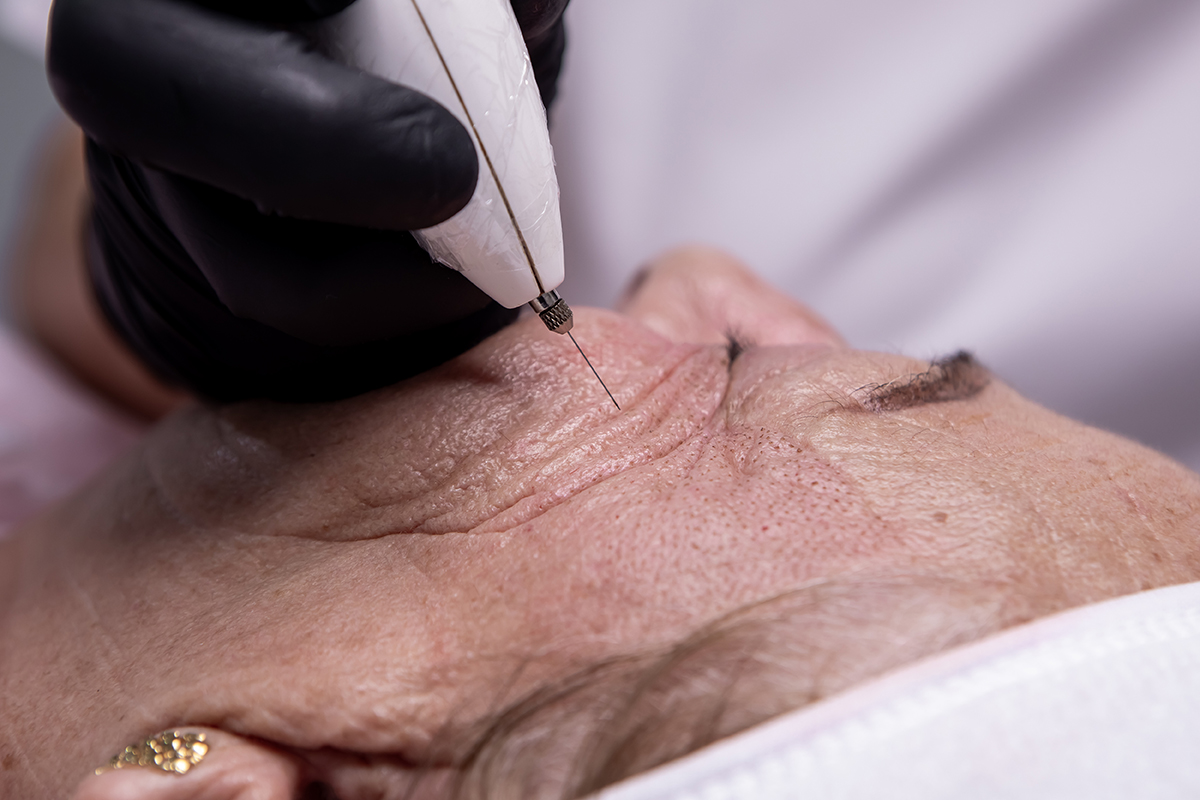 Plasma Pen en Orbicular de los Ojos y Patas de Gallo en Sevilla