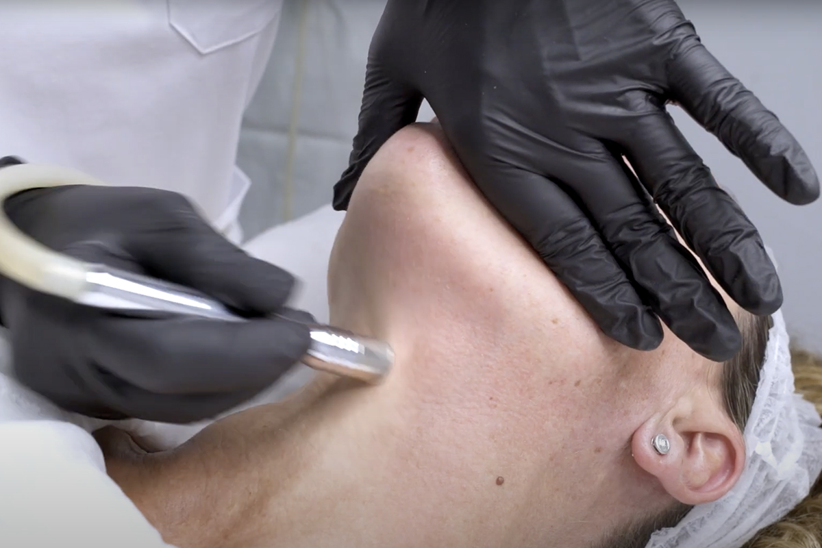 Limpieza Facial con Punta de Diamante en Sevilla