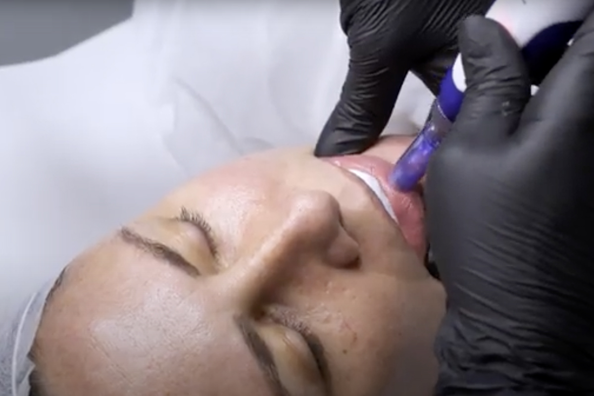 Hidratación de Labios con Hyaluron Pen y Dermapen en Sevilla