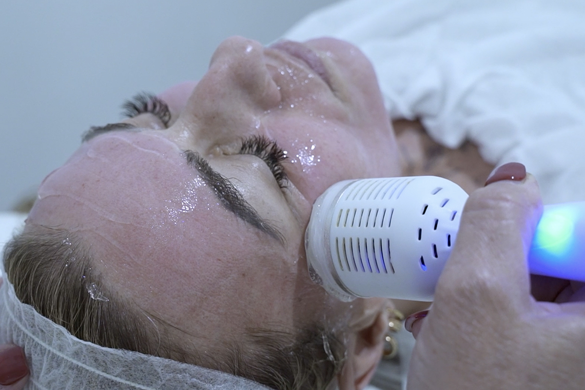 Radiofrecuencia Fraccionada Facial en Sevilla