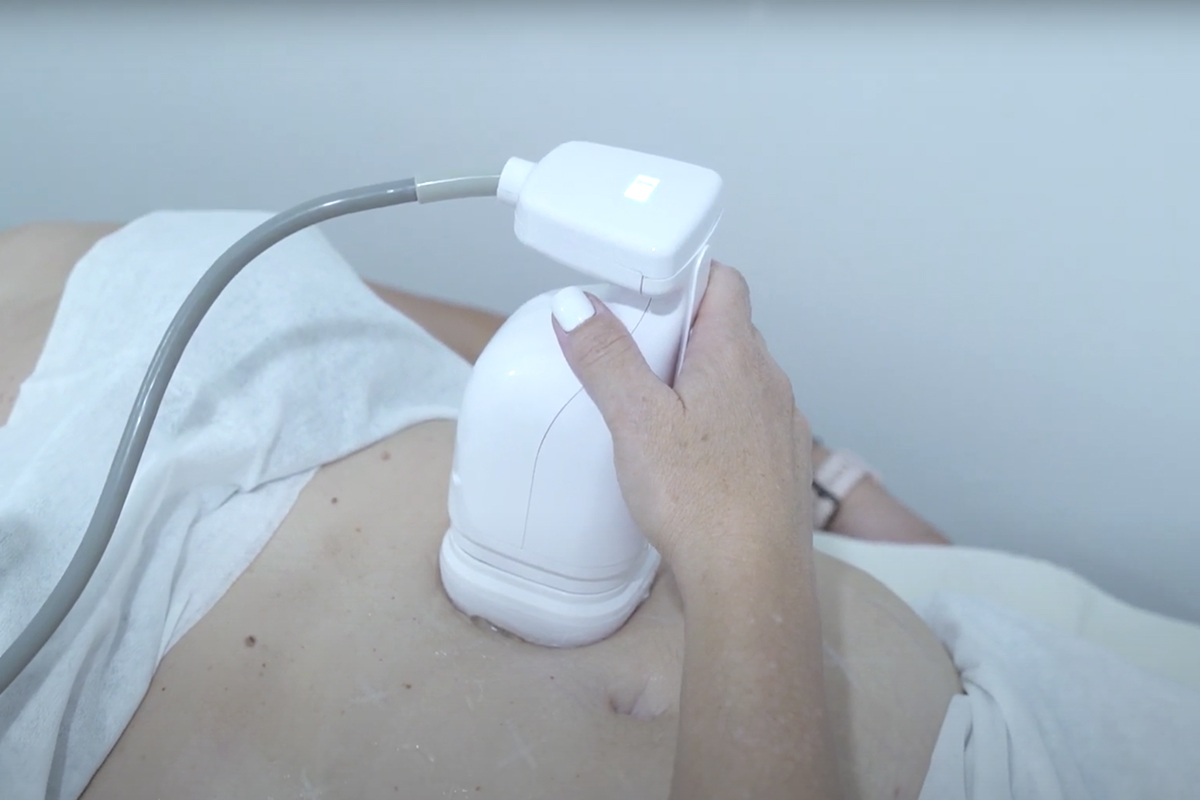 Liposonix e Hifu 7D en Sevilla