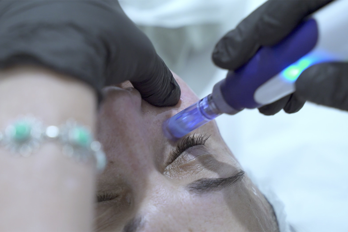 Dermapen Facial en Sevilla