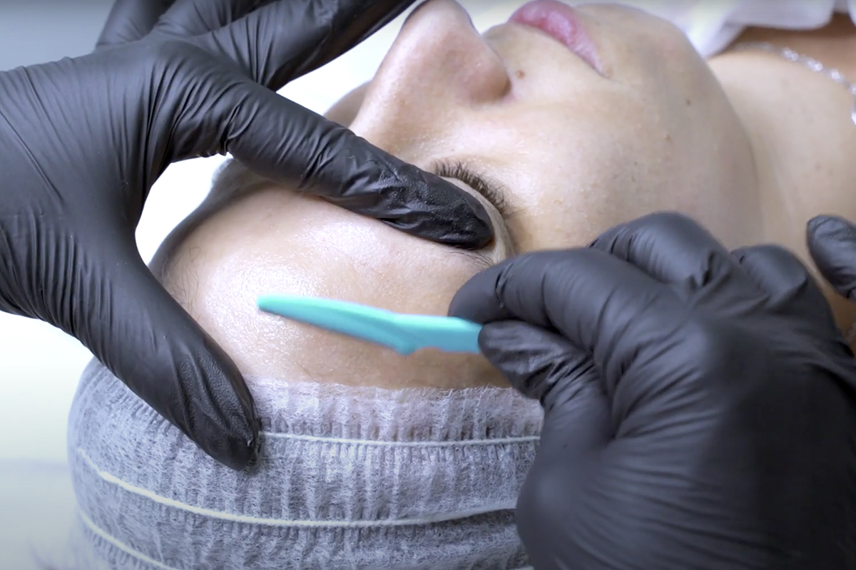 Dermaplaning y Dermapen en Sevilla