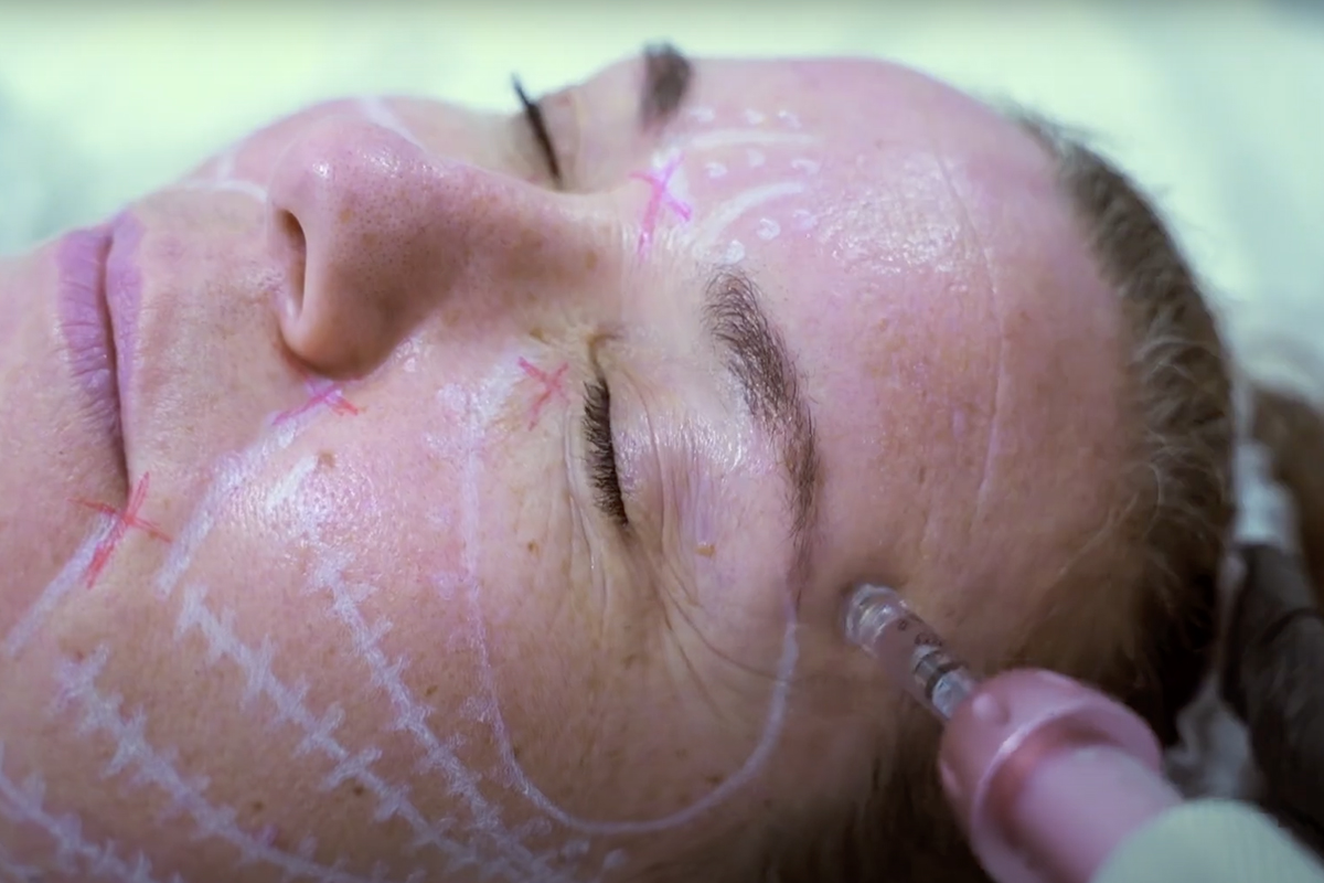 Curso Nanobotox e Hilos Líquidos en Sevilla