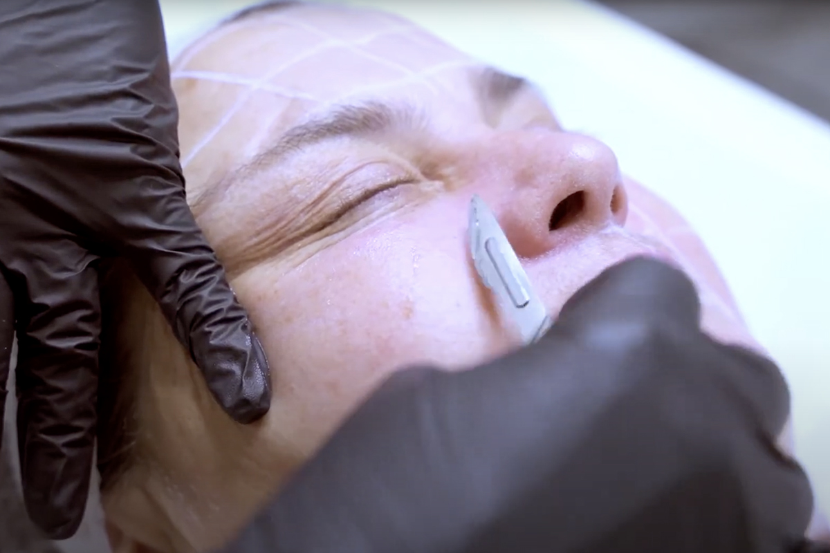 Curso Dermaplaning con Dermapen en Sevilla