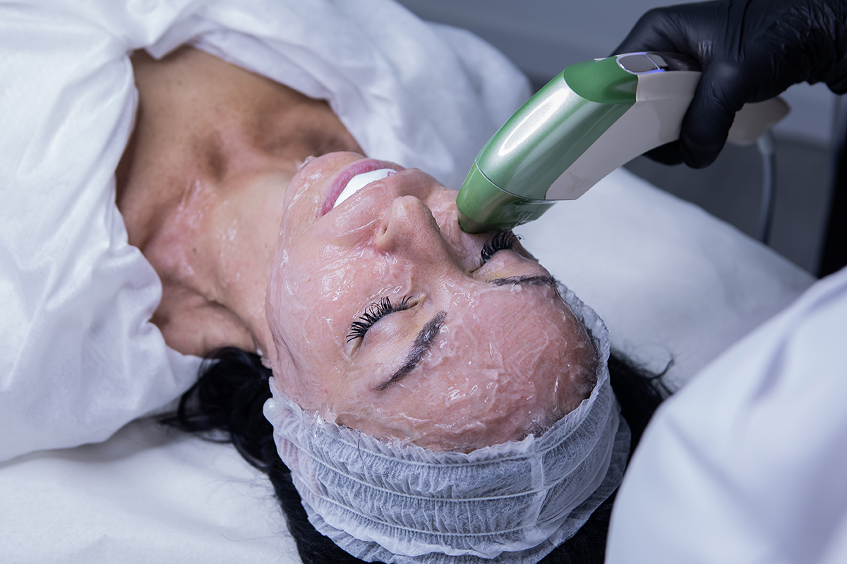 Hifu 12MPT Facial en Sevilla
