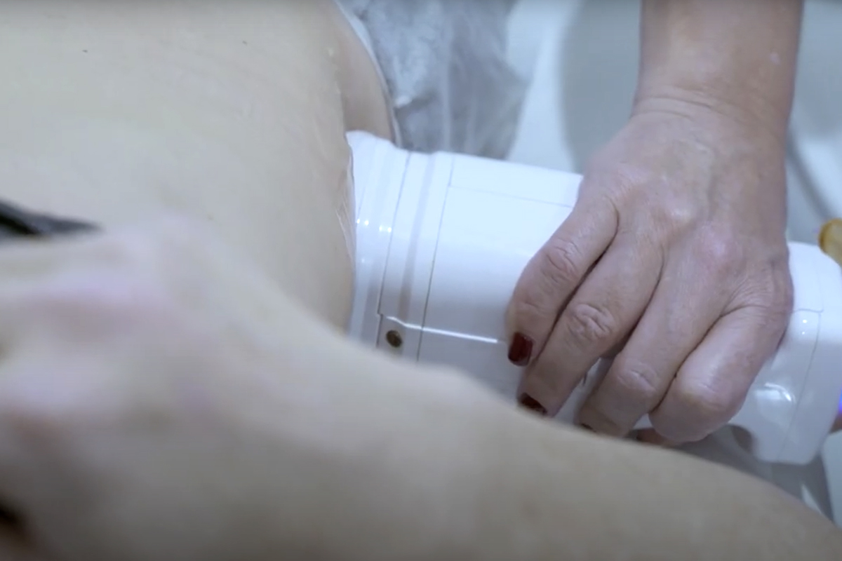 Liposonix en Abdomen en Sevilla