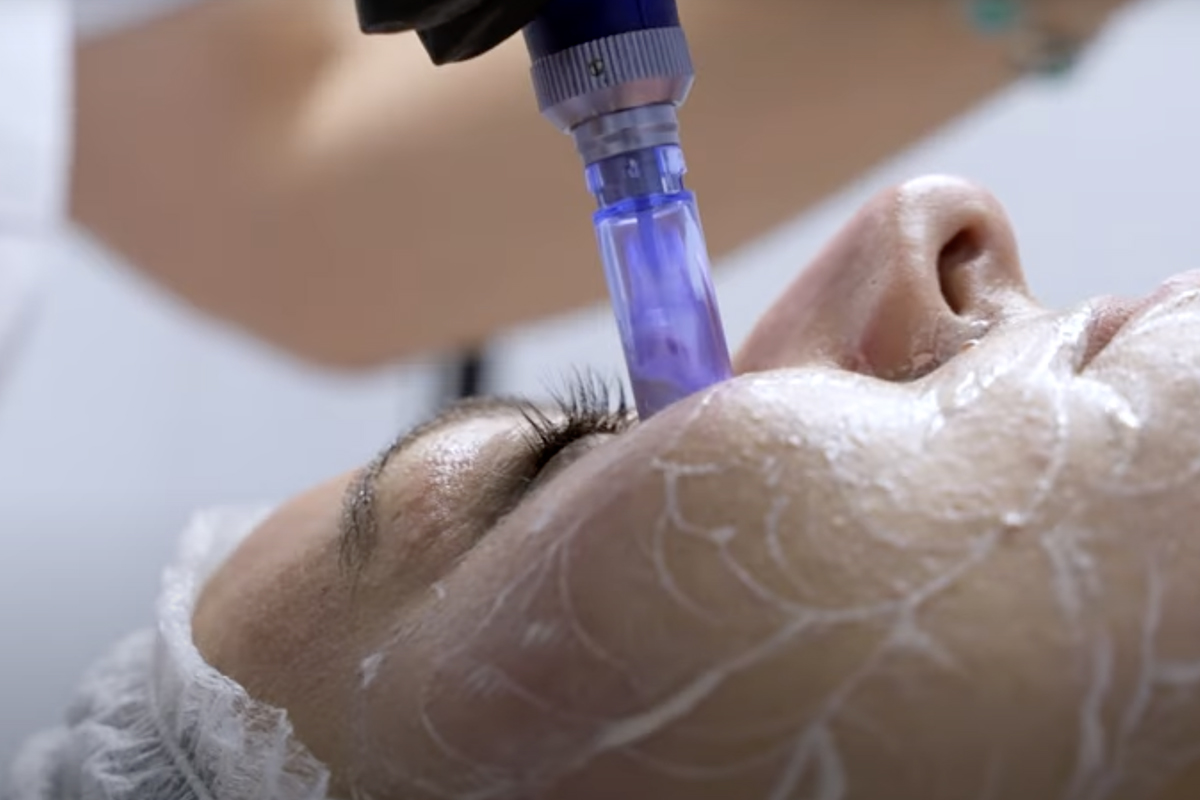 Dermapen y CC Glow en Sevilla