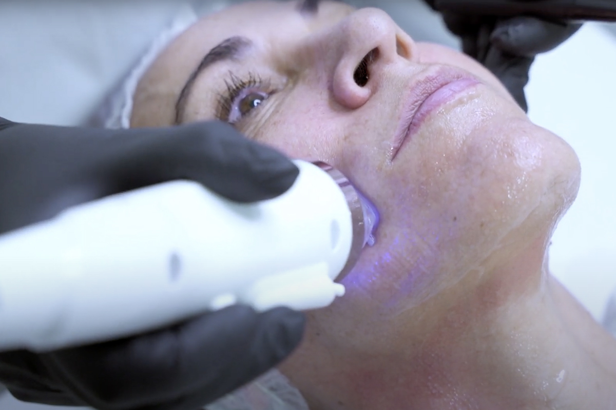 Radiofrecuencia Facial Fraccionada en Sevilla